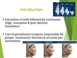 over denture 6666666666 prothodontics.pptx