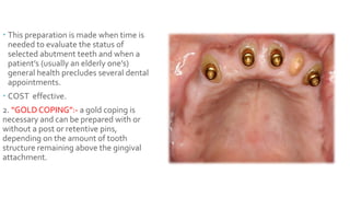 Ast Coping Tooth TOOTH SUPPORTED OVERDENTURES | PPTX