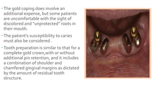 The gold coping does involve an
additional expense, but some patients
are uncomfortable with the sight of
discolored and “unprotected” roots in
their mouth.
 The patient’s susceptibility to caries
must also be considered .
 Tooth preparation is similar to that for a
complete gold crown,with or without
additional pin retention, and it includes
a combination of shoulder and
chamfered gingival margins as dictated
by the amount of residual tooth
structure.
 