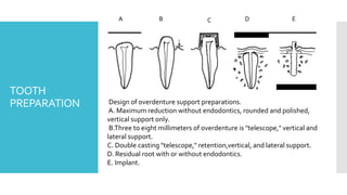 TOOTH
PREPARATION
A B C D E
Design of overdenture support preparations.
A. Maximum reduction without endodontics, rounded and polished,
vertical support only.
B.Three to eight millimeters of overdenture is "telescope," vertical and
lateral support.
C. Double casting "telescope," retention,vertical, and lateral support.
D. Residual root with or without endodontics.
E. Implant.
 