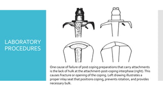 LABORATORY
PROCEDURES
One cause of failure of post coping preparations that carry attachments
is the lack of hulk at the attachment-post-coping interphase (right).This
causes fracture or opening of the coping. Left drawing illustrates a
proper inlay seat that positions coping, prevents rotation, and provides
necessary bulk.
 
