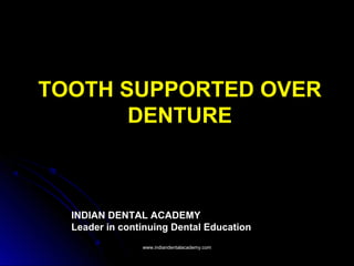 TOOTH SUPPORTED OVERTOOTH SUPPORTED OVER
DENTUREDENTURE
INDIAN DENTAL ACADEMY
Leader in continuing Dental Education
www.indiandentalacademy.comwww.indiandentalacademy.com
 