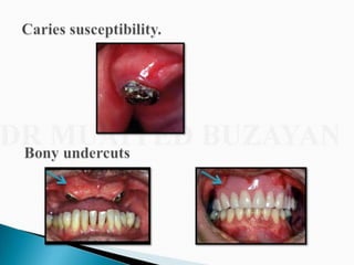 Overdentures and attachments part 1