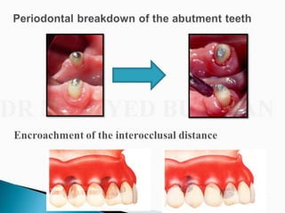 Overdentures and attachments part 1
