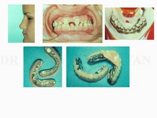 Overdentures and attachments part 1