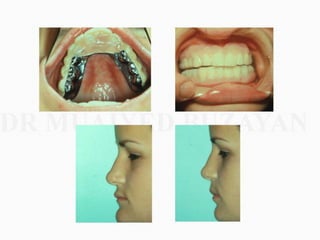 Overdentures and attachments part 1