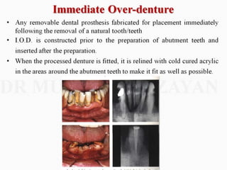 Overdentures and attachments part 1