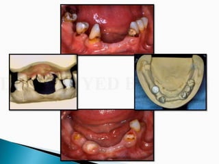 Overdentures and attachments part 1