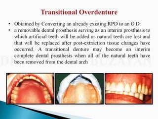 Overdentures and attachments part 1
