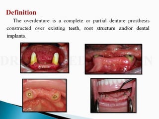 Overdentures and attachments part 1