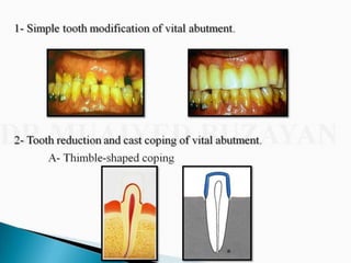 Overdentures and attachments part 1