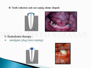 Overdentures and attachments part 1