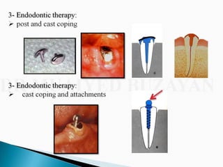 Overdentures and attachments part 1