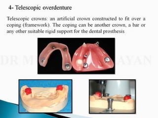 Overdentures and attachments part 1