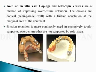 Overdentures and attachments part 1