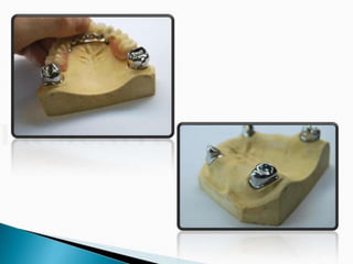 Overdentures and attachments part 1