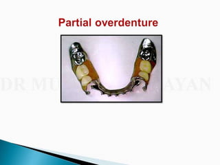 Overdentures and attachments part 1