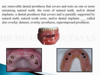 Overdentures and attachments part 1