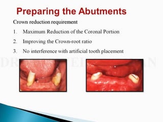 Overdentures and attachments part 1