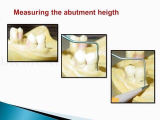 Overdentures and attachments part 1