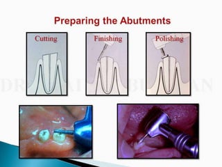 Overdentures and attachments part 1