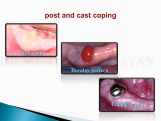 Overdentures and attachments part 1