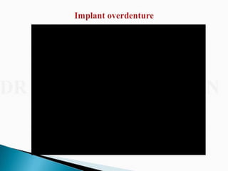 Overdentures and attachments part 1