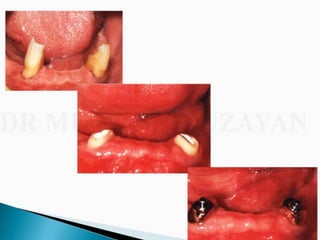 Overdentures and attachments part 1