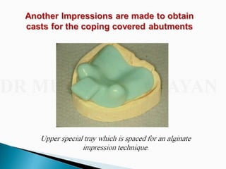 Overdentures and attachments part 1