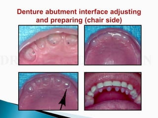 Overdentures and attachments part 1