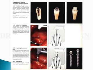 Overdentures and attachments part 1
