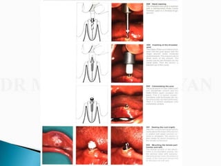 Overdentures and attachments part 1
