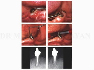 Overdentures and attachments part 1