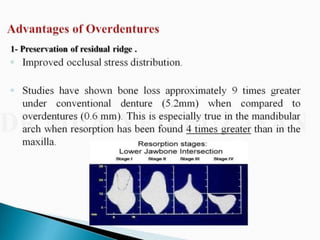 Overdentures and attachments part 1