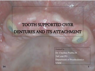 TOOTH SUPPORTED OVER
DENTURES AND ITS ATTACHMENT
Presented by,
Dr. Chaithra Prabhu B
2nd year PG
Department of Prosthodontics
VSDC
184
 