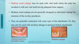 Ast Coping Tooth tooth supported Overdentures | PPTX