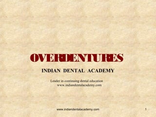 OVERDENTURES
INDIAN DENTAL ACADEMY
Leader in continuing dental education
www.indiandentalacademy.com
1www.indiandentalacademy.com
 