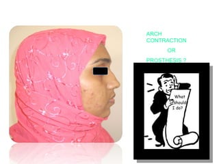 ARCH 
CONTRACTION 
OR 
PROSTHESIS ? 
 