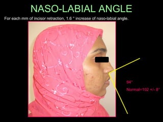 NASO-LABIAL ANGLE 
For each mm of incisor retraction, 1.6 ° increase of naso-labial angle. 
94° 
Normal=102 +/- 8° 
 
