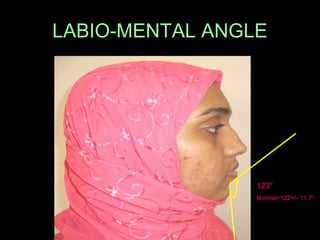 LABIO-MENTAL ANGLE 
123° 
Normal=122+/- 11.7° 
 