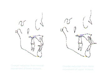Overjet reduction from mesial 
movement of lower incisors. 
Overjet reduction from distal 
movement of upper incisors. 
 