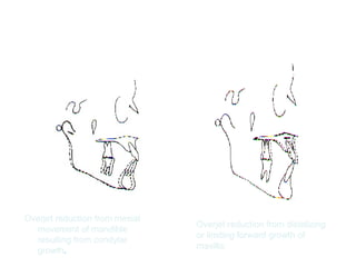 Overjet reduction from mesial 
movement of mandible 
resulting from condylar 
growth. 
Overjet reduction from distalizing 
or limiting forward growth of 
maxilla. 
 