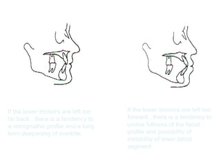 If the lower incisors are left too 
far back , there is a tendency to 
a retrognathic profile and a long 
term deepening of overbite. 
If the lower incisors are left too 
forward , there is a tendency to 
undue fullness of the facial 
profile and possibility of 
instability of lower labial 
segment. 
 