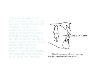 • There is usually a soft 
tissue involvement when 
require mesial movement 
of lower incisors. For 
example , if there is a 
history of thumb sucking 
activity or hyperactive 
mentalis muscle function 
where lower incisors have 
been held back and 
retroclined. In these 
cases , it is mechanically 
appropriate to move the 
lower incisors forward. 
 