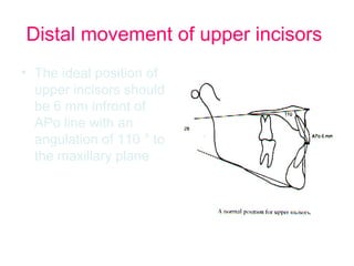 Distal movement of upper incisors 
• The ideal position of 
upper incisors should 
be 6 mm infront of 
APo line with an 
angulation of 110 ° to 
the maxillary plane 
 