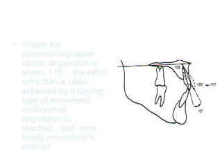 • Where the 
commencing upper 
incisor angulation is 
above 115° , the initial 
retraction is often 
achieved by a tipping 
type of movement 
until normal 
angulation is 
reached , and then 
bodily movement is 
attempt. 
 