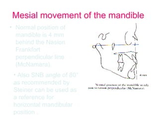 Mesial movement of the mandible 
• Normal position of 
mandible is 4 mm 
behind the Nasion 
Frankfort 
perpendicular line 
(McNamara). 
• Also SNB angle of 80° 
as recommended by 
Steiner can be used as 
a reference for 
horizontal mandibular 
position . 
 