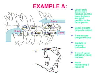 EXAMPLE A:  Lower arch 
contraction 
finished and the 
lower incisors 
are good 
position in the 
facial profile. 
 Upper incisors 
torque is correct 
 3 mm excess 
overjet to close 
 overbite is 
properly 
controlled 
 6 mm of upper 
extraction need 
to close 
 Molar 
relationship 3 
mm cl-III 
6 mm 
3 mm 
3 mm 
 