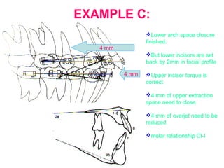 EXAMPLE C: 
Lower arch space closure 
finished. 
But lower incisors are set 
back by 2mm in facial profile 
Upper incisor torque is 
correct 
4 mm of upper extraction 
space need to close 
4 mm of overjet need to be 
reduced 
molar relationship Cl-I 
4 mm 
4 mm 
 