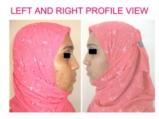 LEFT AND RIGHT PROFILE VIEW 
 
